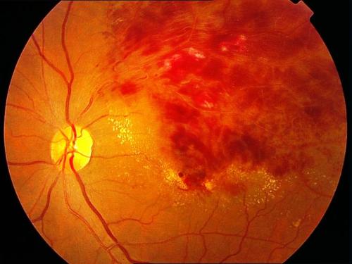 双眼黄斑病变中医怎么治疗？