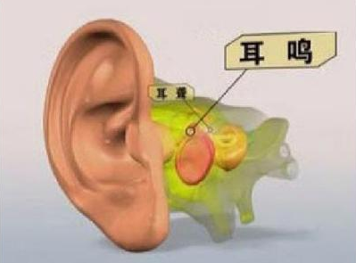 耳鸣的治疗方法有哪些？
