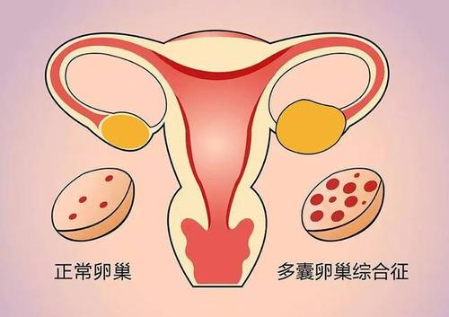 多囊卵巢综合征月经不调中医怎么调理比较好？