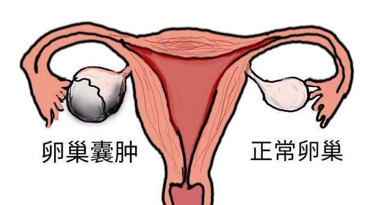 卵巢囊肿不孕吃什么中药可能调理好？