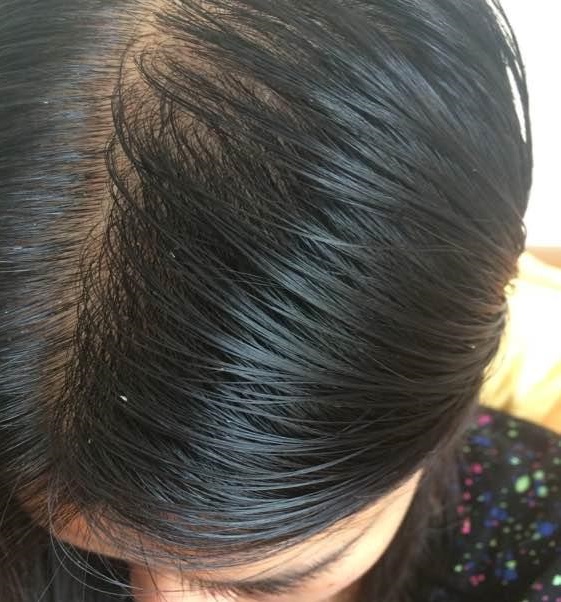 脂溢性脱发头皮油腻脱屑瘙痒头发越来越稀疏中医怎么治疗比较好