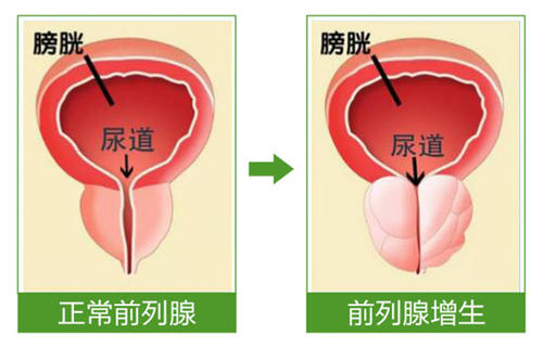 前列腺增生症小便淋漓排尿困难吃什么中药能缓解？