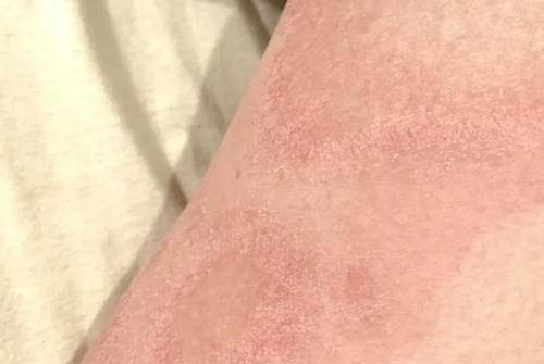 慢性湿疹左小腿前侧皮肤粗糙增厚瘙痒10年反复发作怎么治疗能调理好？