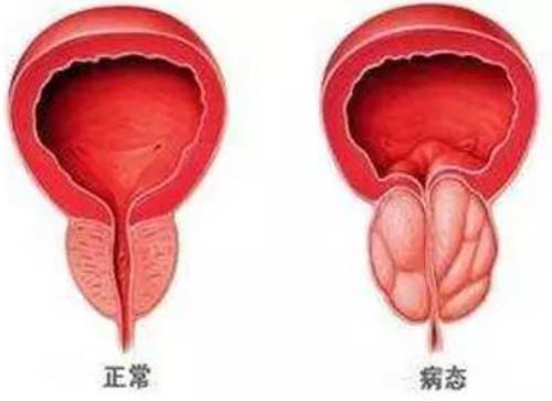 前列腺增生尿频每小时小便6次尿量少点滴难出怎么治好？
