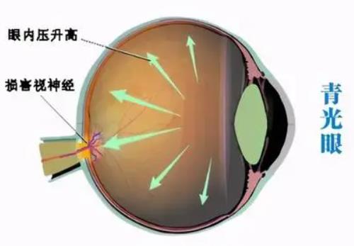 武汉眼科名老中医丁辛博士：青光眼2年，双眼发胀干涩，头重痛，怎么治疗能恢复好？
