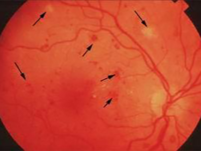 视网膜静脉周围炎有哪些症状？