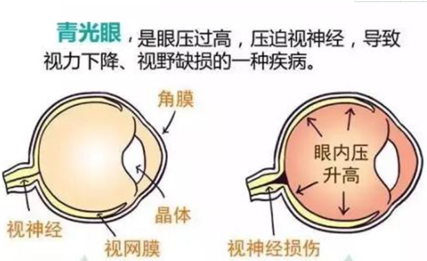 青光眼有哪些症状怎么治疗?