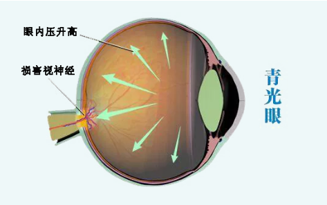 青光眼视力下降怎么治疗？