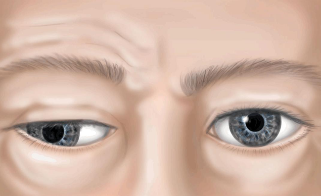 眼肌麻痹上眼睑中医怎么治疗？