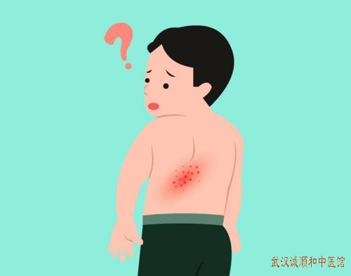 病毒性疱疹背部起红色丘疹，又痛又痒反复发作用什么方法治疗好？