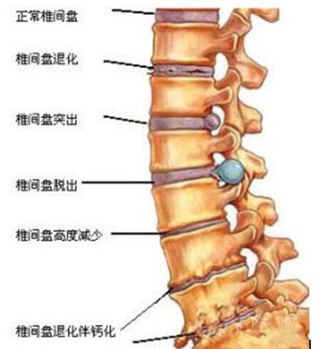 腰椎间盘突出是什么症状？腰痛、腿痛、腰腿痛其突出的位置各不同