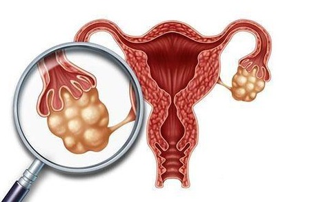 卵巢囊肿小肚子特别不舒服怎么办？
