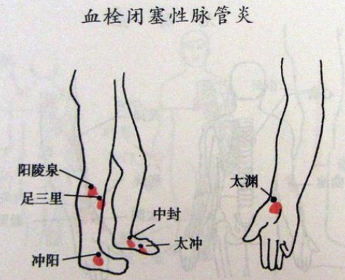 下肢脉管炎手脚发凉酸痛无力夜晚加重吃什么中药能治好？