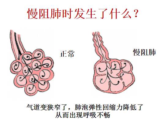 慢阻肺中医治疗