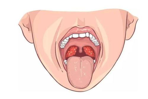 小儿化脓性扁桃体炎中医治疗