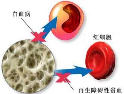 再生障碍性贫血身体无力心悸气短吃什么中药能治好？