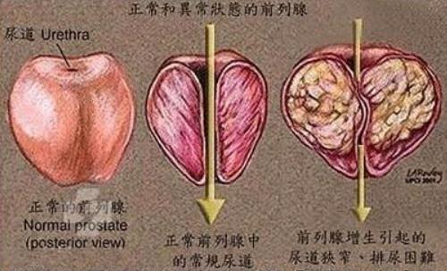 前列腺肥大12年排尿困难夜尿多吃什么药能治好？徐长化教授辨证论治有好方