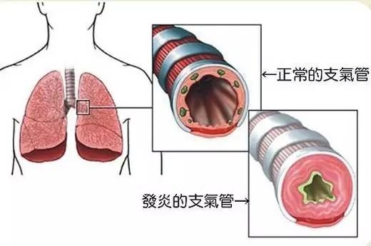 支气管炎怎么治疗？