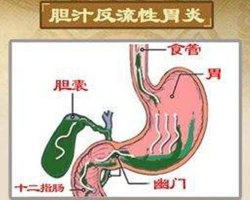 胆汁反流性胃炎症状有哪些？