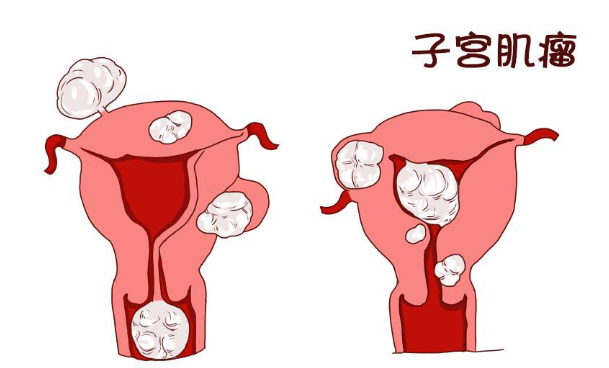 子宫肌瘤有哪些症状？