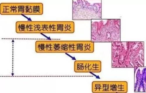 慢性萎缩性胃炎胃脘疼痛怕冷泛酸口干苦怎么调理好？