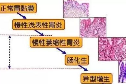 武汉胃肠科医院名老中医王垚：慢性萎缩性胃炎伴轻度肠化胃部刺痛饭后加重怎么调理好？