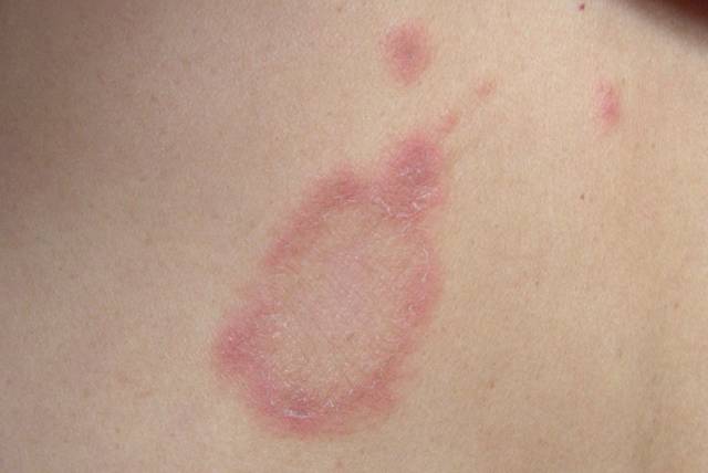 玫瑰糠疹需要怎么治疗见效快？