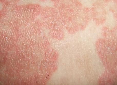 武汉皮肤病专家胡爱玲慢性湿疹急性发作皮肤潮红起红疹痒得难受怎么办