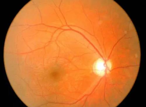 武汉眼科名老中医丁辛博士：视神经萎缩4年，视物模糊眼胀、前额疼痛怎么治疗效果好？