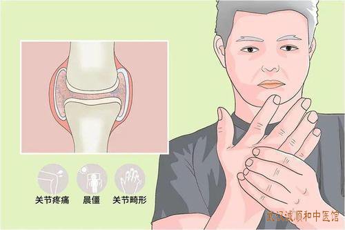 骨性关节炎疼痛中医治疗医案