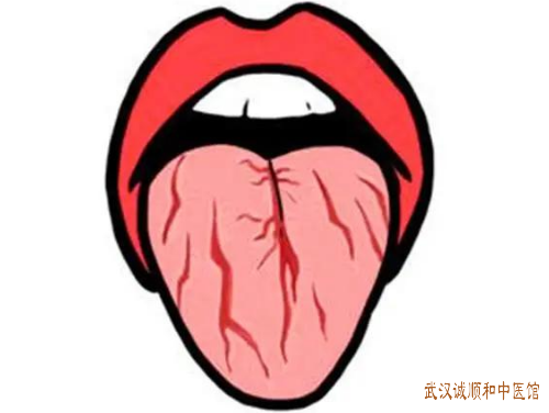 裂纹舌中医怎么辨证治疗？
