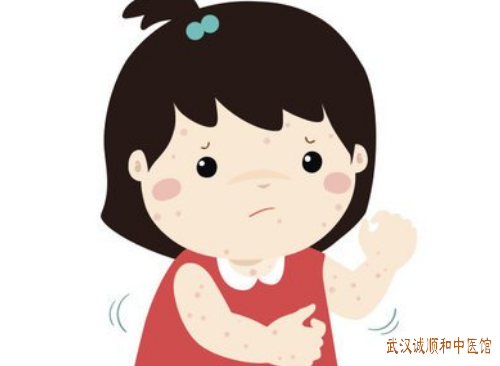 单纯性痒疹全身起小疹子中医治疗医案一则