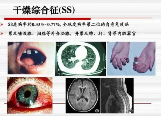 中医对于干燥综合征病因病机的认识概述