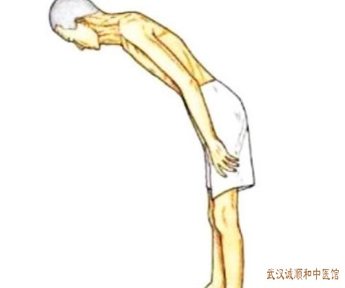 武汉诚顺和中医风湿专家宋跃进强直性脊柱炎医案一则