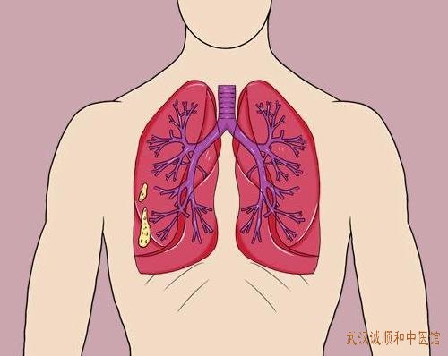 武汉街道口中医门诊老中医钟明教授肺结节医案一则