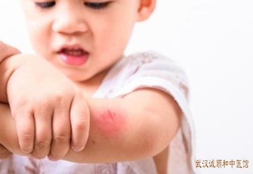 黄石有名的儿科中医王大宪：小儿荨麻疹身上刮痕明显睡眠质量差中医怎么治?