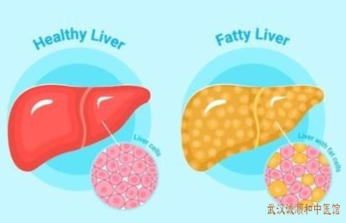 湖北省中医院退休专家李轩锦：脂肪肝右胁隐痛腰酸乏力中医能治好吗?