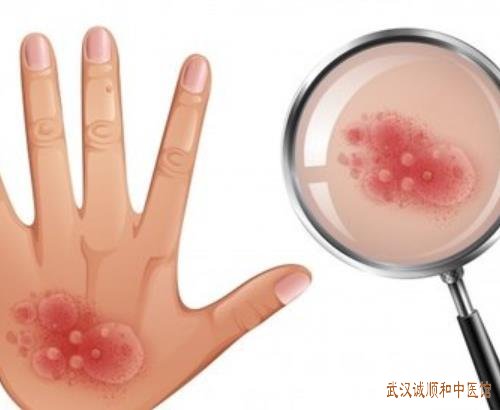 中医皮肤科主任王儒英教授：湿疹双手掌起泡瘙痒反复发作中医怎么用药好?