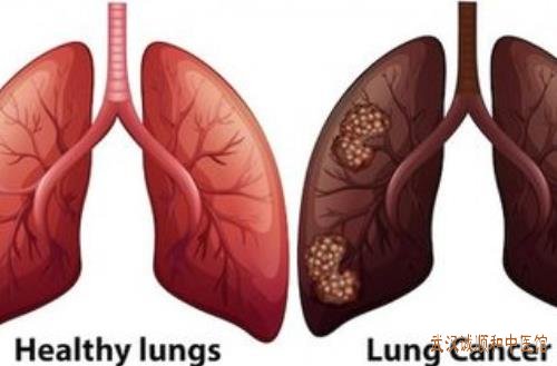 武汉疑难杂症名中医李轩锦：原发支气管肺癌胸闷口干口苦中医治疗生活质量改善医案一则。