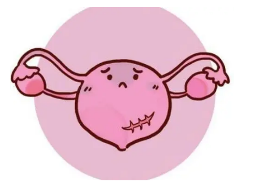 慢性盆腔炎