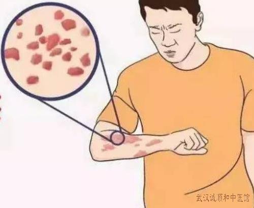 武汉皮肤科中医厉害专家：过敏性紫癜反复呈紫红色伴瘙痒怎么治疗？