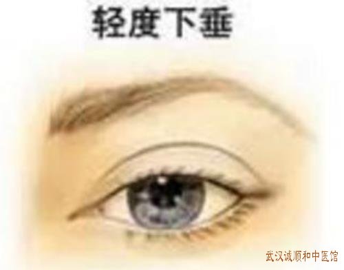 武汉武昌武珞路有位厉害的老中医：眼肌无力双眼睑下垂食纳变差怎么治疗？