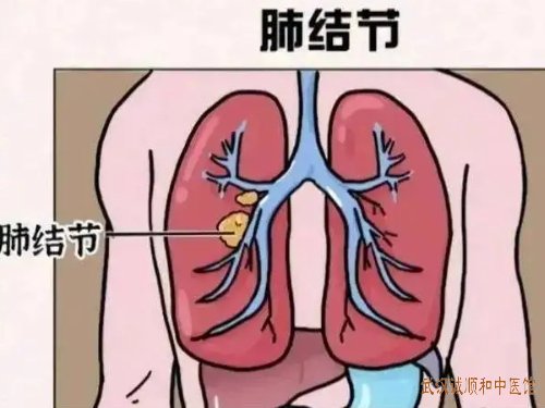 武汉卓刀泉路胸内科中医院：中年女性肺结节直径5mm偶有胸闷感用什么中药方能治好？