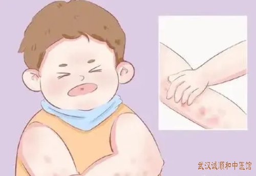 武汉关东街道有个厉害的皮肤科老中医：手部神经性皮炎皮肤粗糙肥厚瘙痒中药怎么治好？