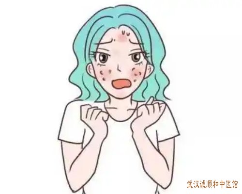 武汉光谷大道珞喻东路皮肤科老中医：青年人痤疮面部前胸后背丘疹伴脓疱中药怎么治好？