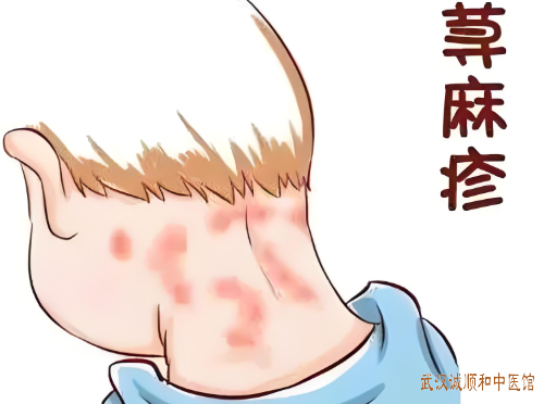 武汉武昌中山路厉害皮肤病中医专家：中老年人荨麻疹反复发作皮肤瘙痒伴搔之成片怎么调理？
