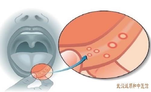 武汉看口腔科哪个医院好?中年人口腔溃疡反复发作口干口苦伴大便不成形如何调理好?