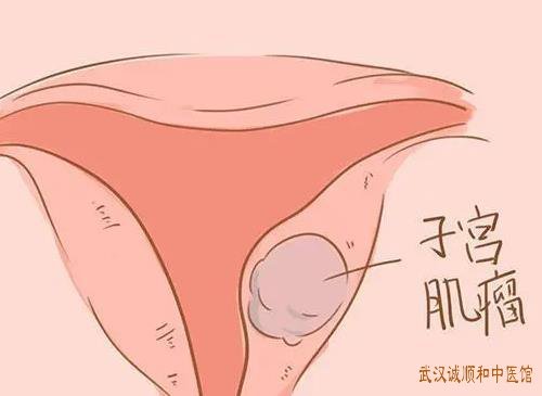 武汉妇科中医调理哪个医院好？子宫肌瘤小腹冷痛拒按得热则减伴经色暗紫夹血块中医怎么调？