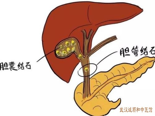 武汉看胆结石厉害的中医专家有哪些？胆结石右上腹疼一年伴有呕吐中医怎么治疗好？